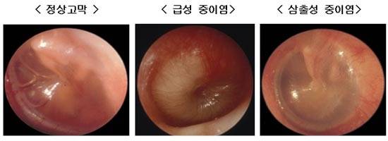 이 사진의 급성 중이염과 닮은 모습이었다 (메디컬월드뉴스)
